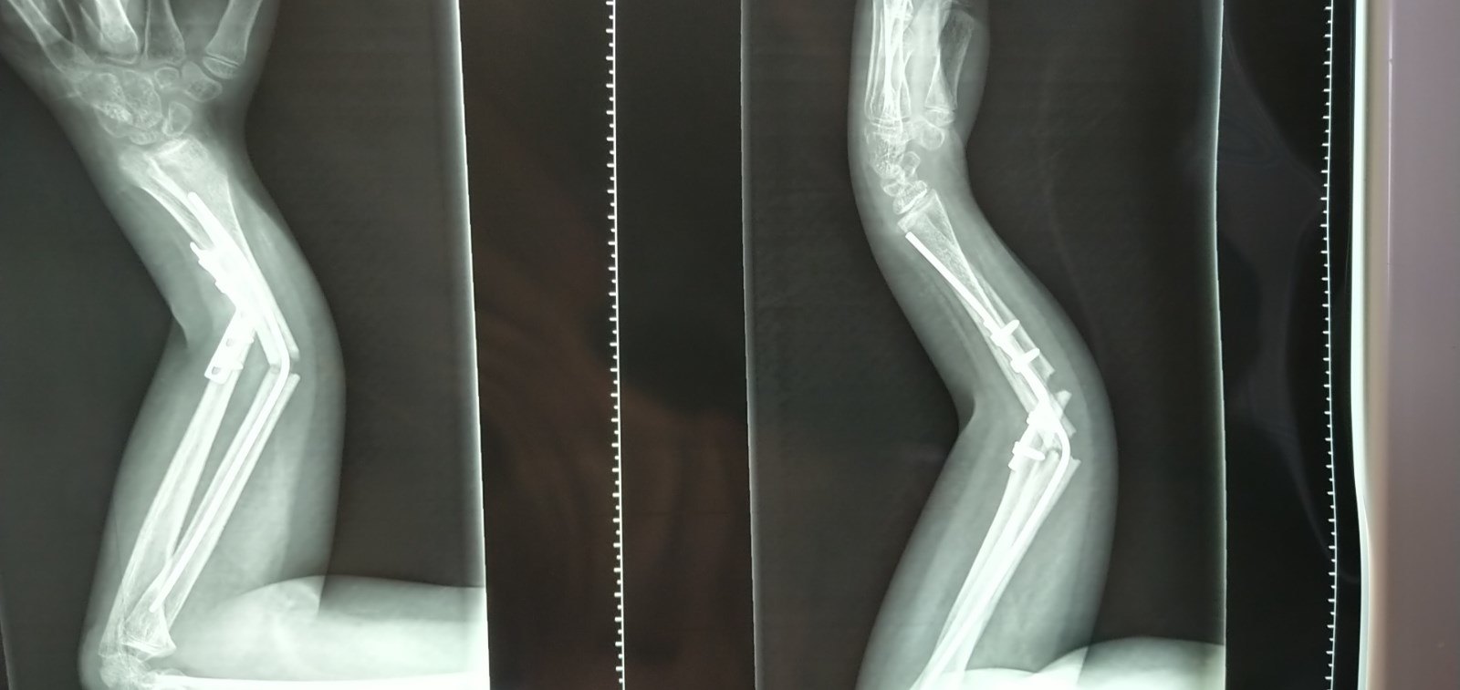 典型病例-儿童尺桡骨骨干骨折后再骨折的处理 - 好大夫在线