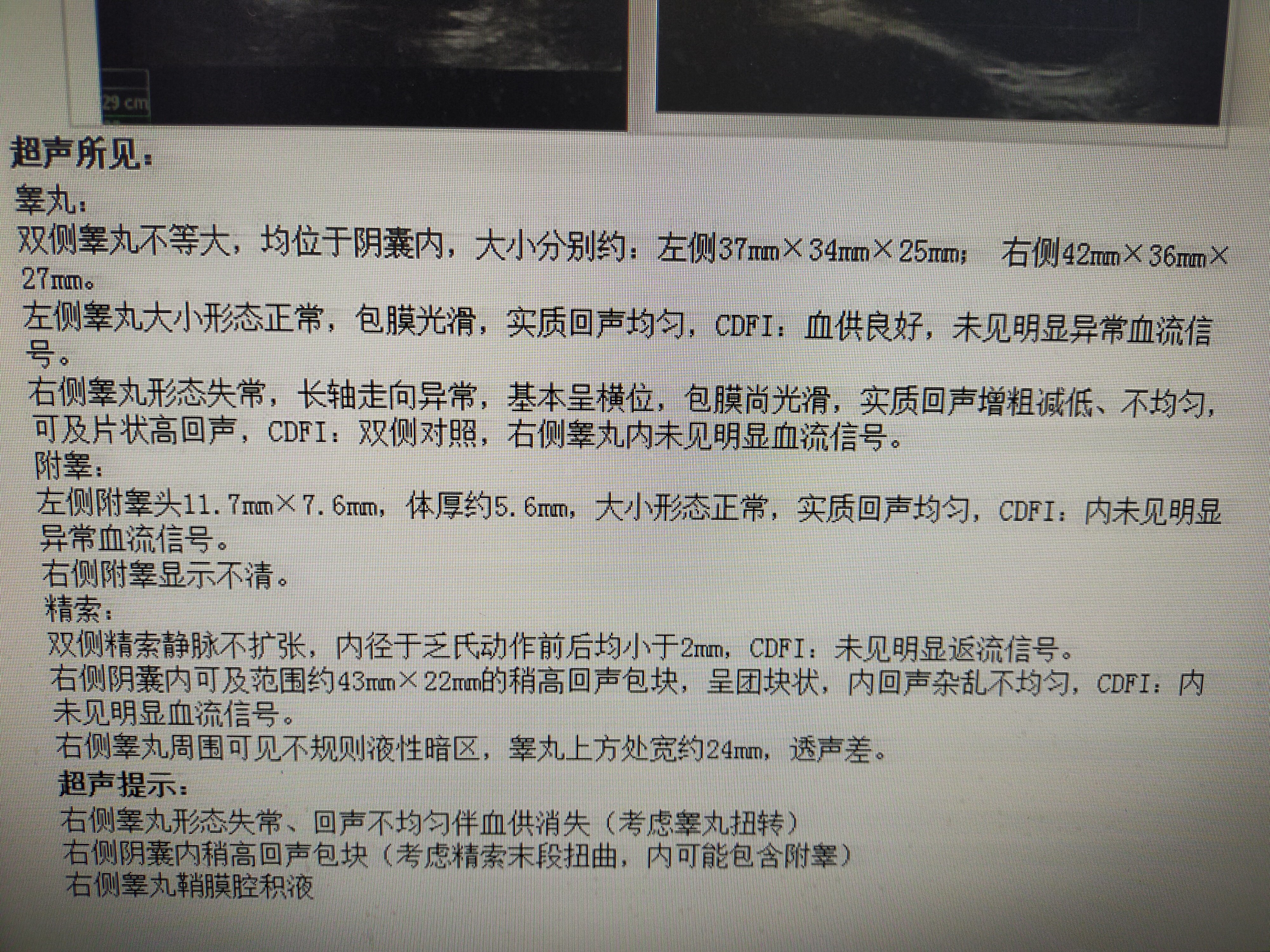 如何发现睾丸扭转