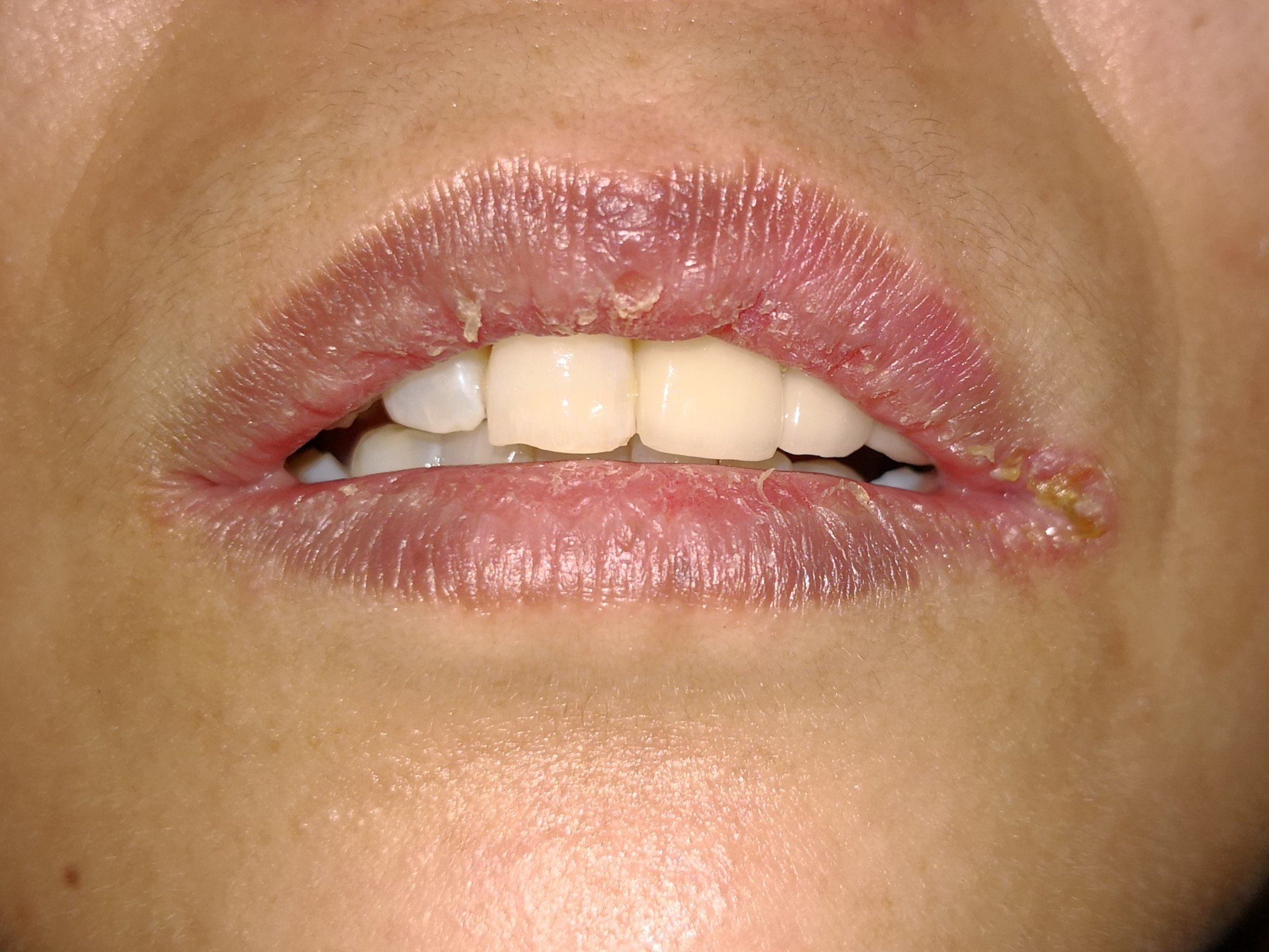 口腔念珠菌感染的病因症状临床表现和治疗