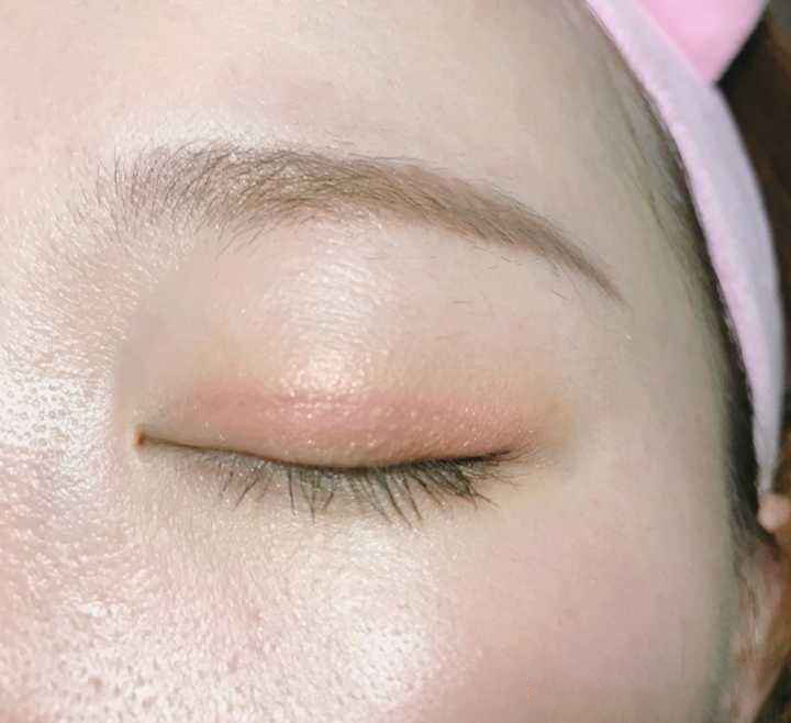 双眼皮术后为什么会出现闭眼不全?