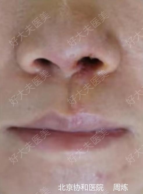 唇腭裂