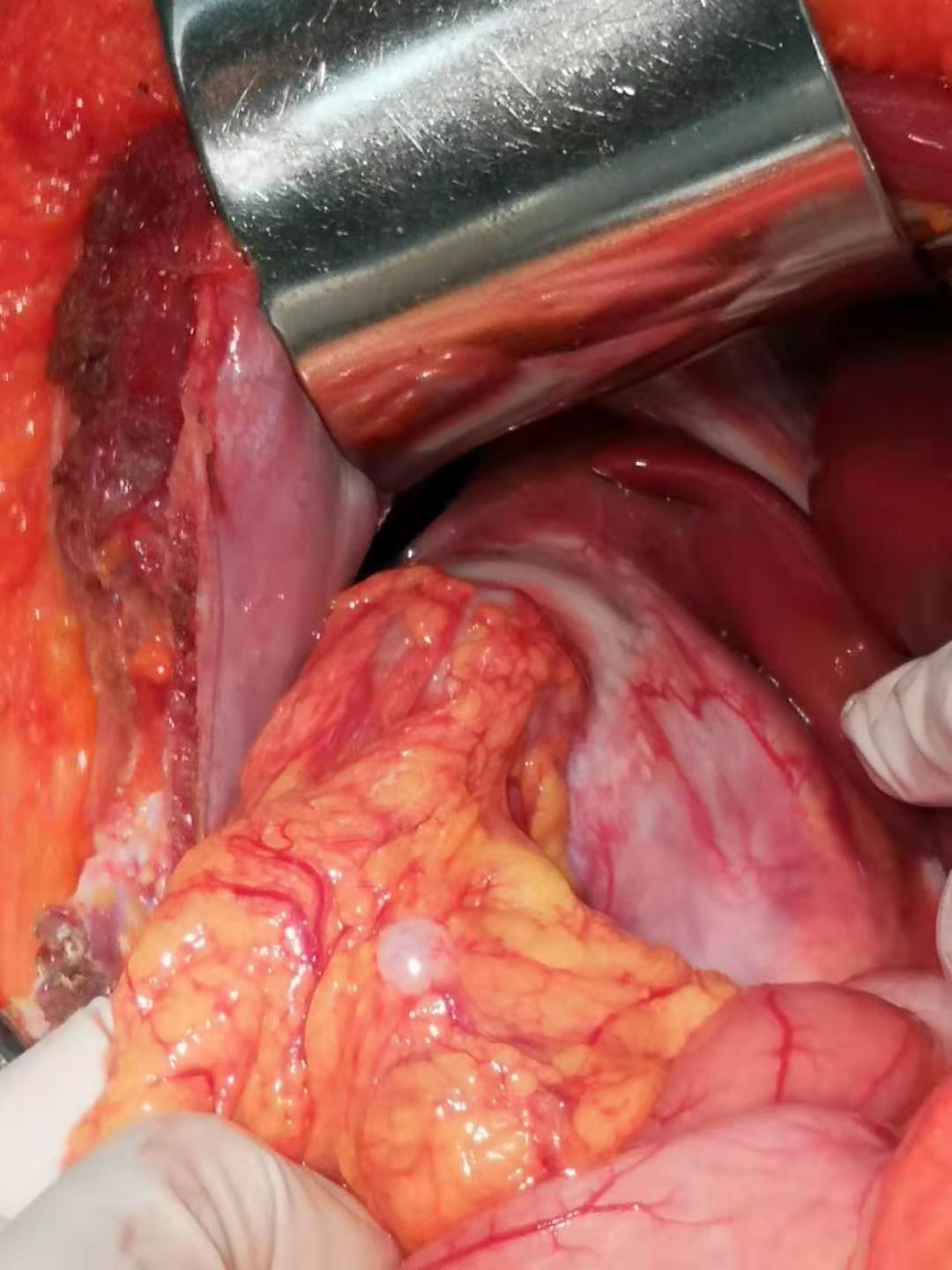 肝胆胰肿瘤低龄化趋势来临 - 好大夫在线