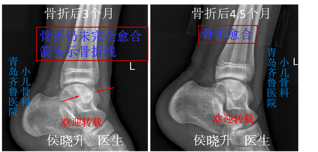 孩子脚扭伤了 当心是骨折 请及时到小儿骨科就诊 踝部扭伤 踝部扭伤 孩子脚扭伤了 当心是骨折 请及时到小儿骨科就诊 踝部扭伤 踝部扭伤