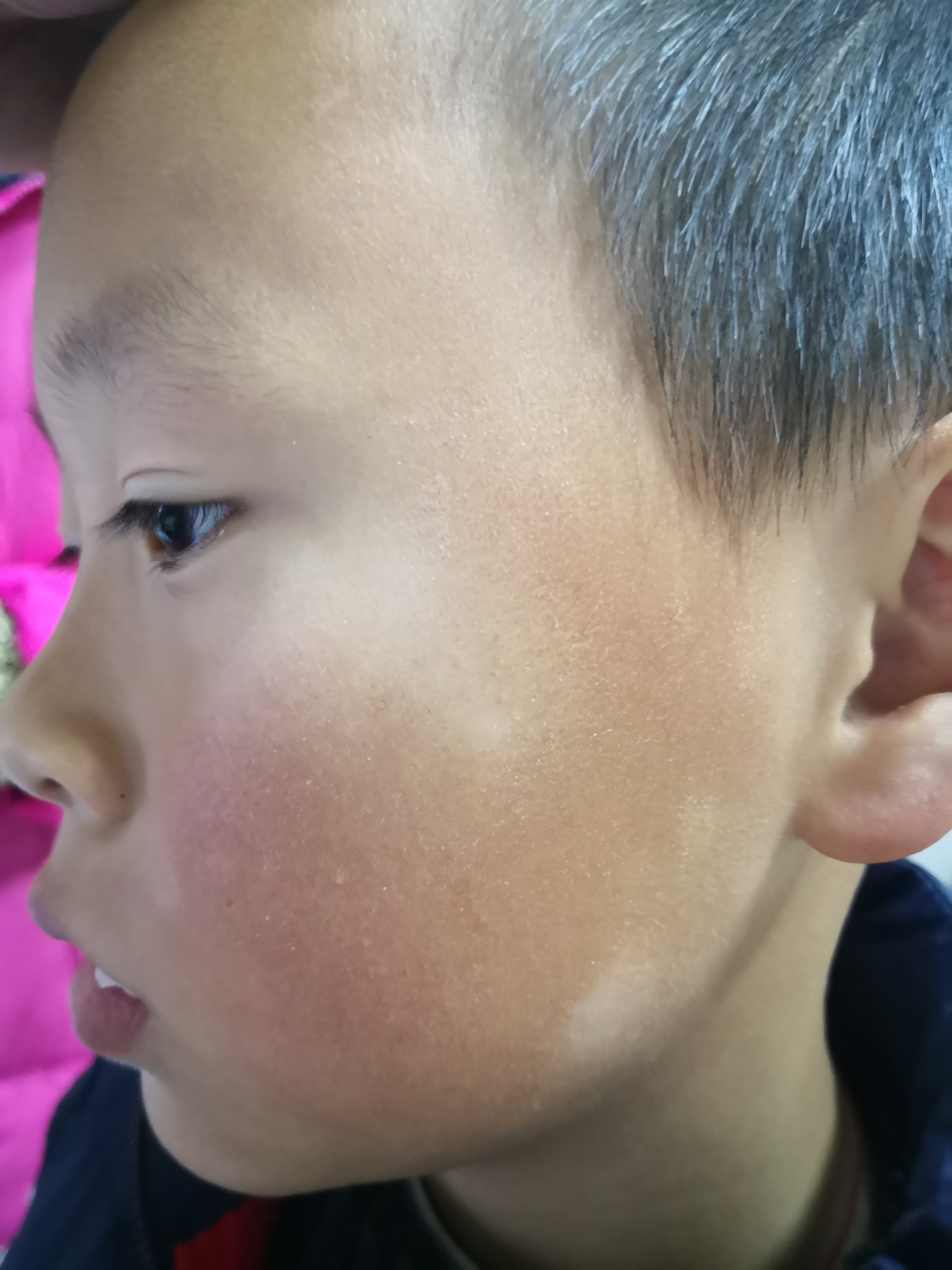 常见于儿童和青少年,好发于面部的鳞屑性色素减退斑.