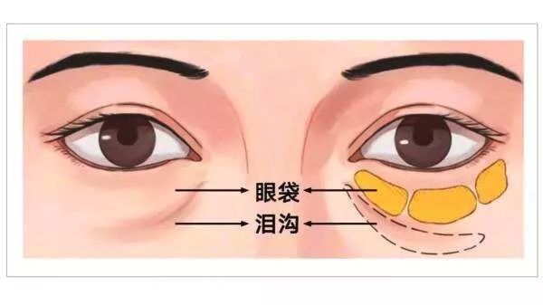 眶隔脂肪释放你适合做吗?_去眼袋_去眼袋治疗介绍 - 好大夫在线