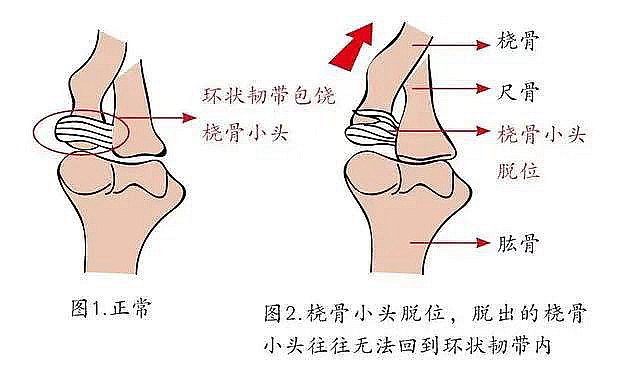 小孩肘部疼痛 哭闹 可能是牵拉后引起的关节脱位 肘关节脱位 小孩肘部疼痛 哭闹 可能是牵拉后引起的关节脱位 肘关节脱位