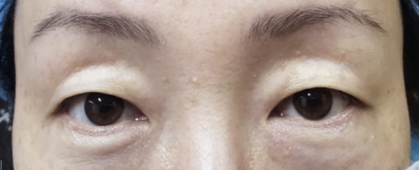 从照片上可以很清楚的看到:眼皮松弛,上眼睑的位置脂肪堆积;内外眼角