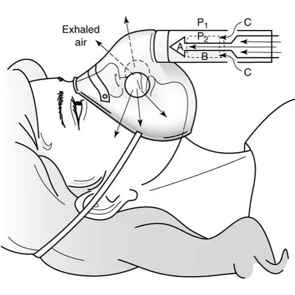 (1)面罩根据venturi原理制成,即氧气经狭窄的孔道进入面罩时,在喷射