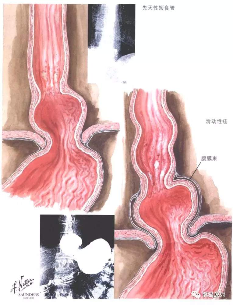 食管裂孔疝是指腹腔內臟器(主要是胃)通過膈食管裂孔進入胸腔所致的