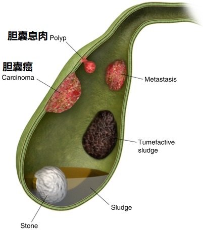 胆囊息肉.jpg