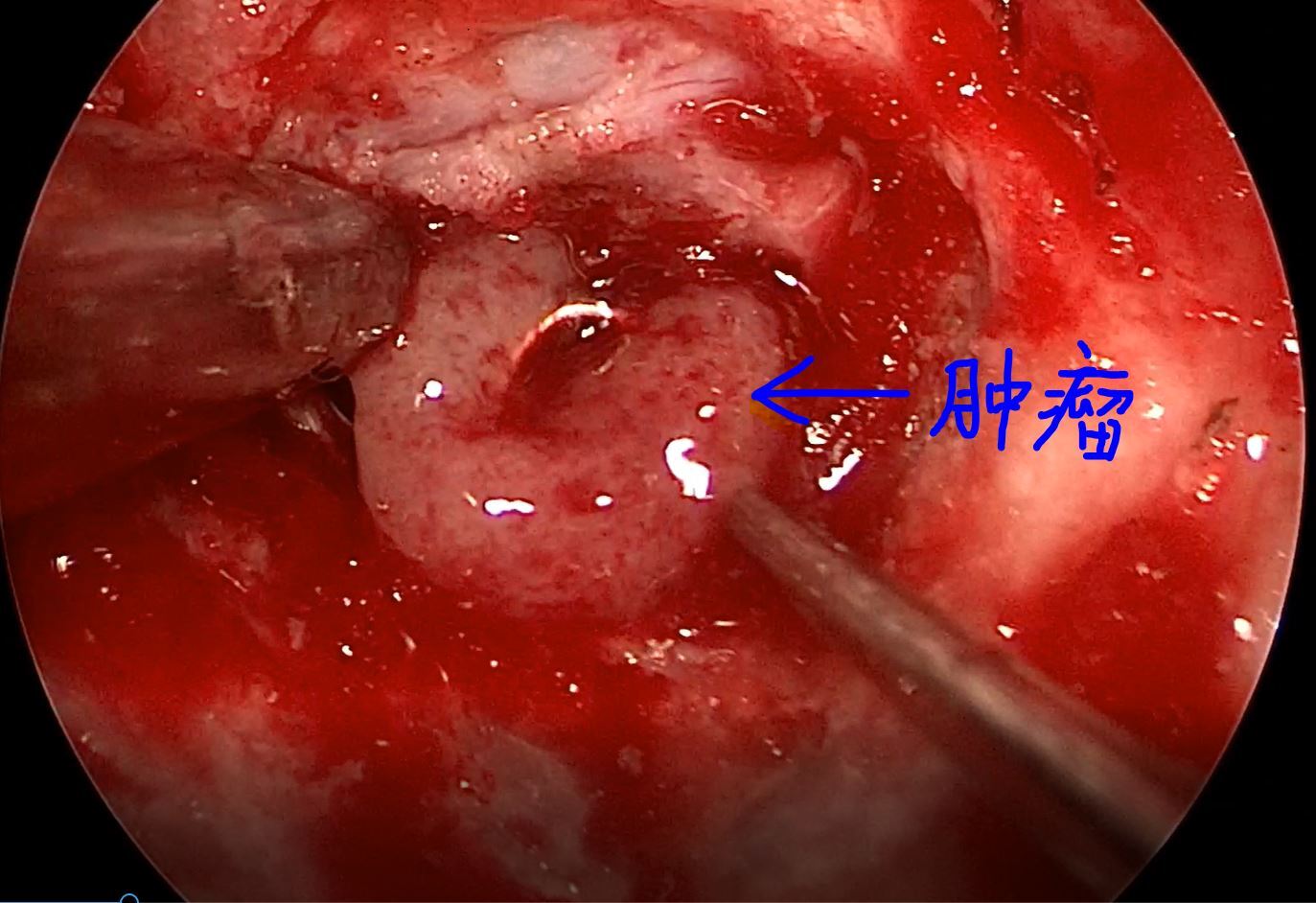 垂体瘤_垂体瘤治疗方式 - 好大夫在线