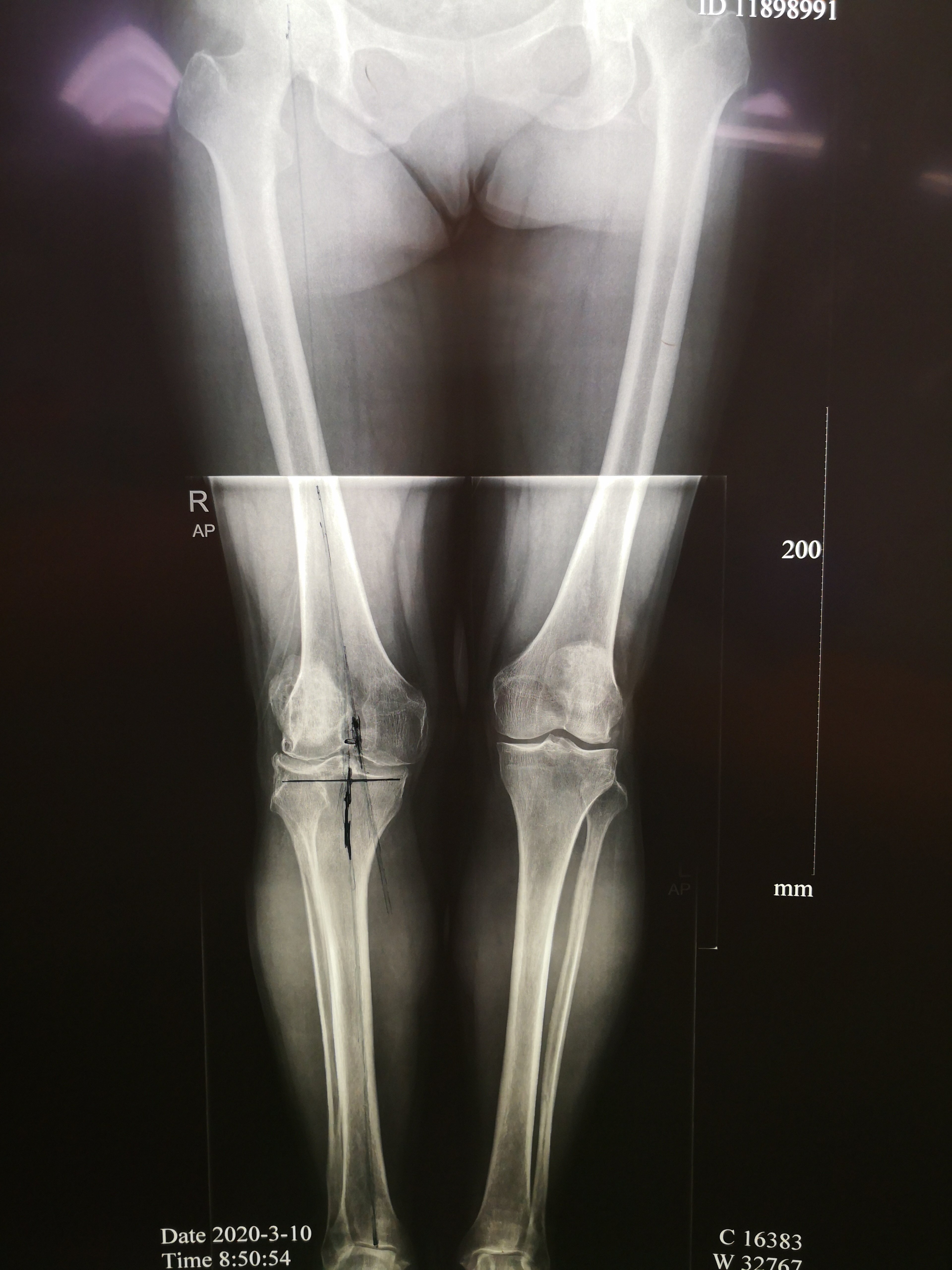 drgs背景下微创髋膝关节置换术的快速康复外科优势 