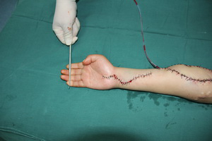 前臂缺血性肌挛缩volkmann挛缩一种灾难性损伤的诊治