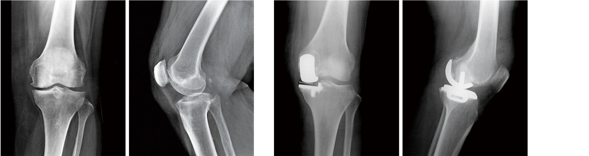 膝关节骨关节炎的阶梯化治疗_膝关节炎_膝关节炎治疗方式 - 好大夫