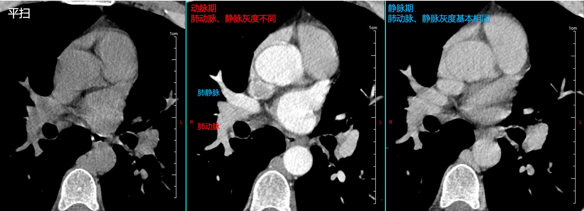 肺部CT图的血管分布图图片
