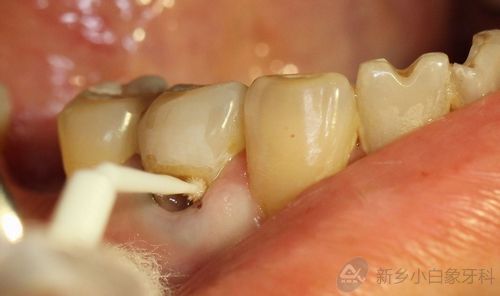 事实上,从前人们将牙颈部非龋源性缺损统称为楔状缺损,后来使用牙颈部