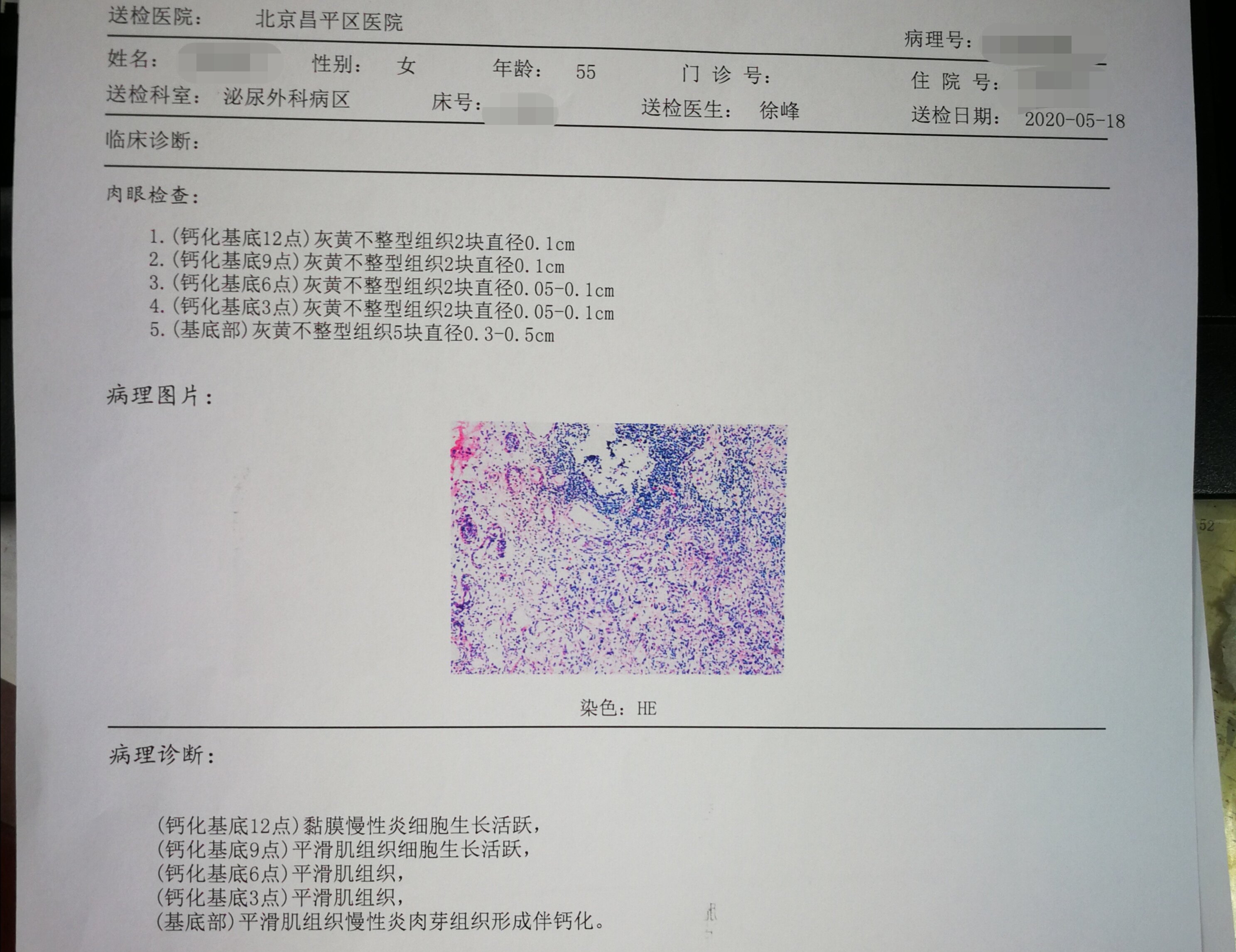 膀胱癌 病理报告图片