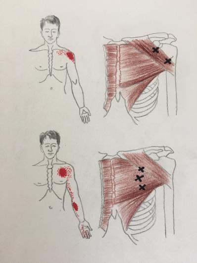 胸背筋膜炎图片