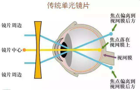 近视防控新武器离焦镜片&角膜塑形镜_近视_如何预防_治疗方式 好