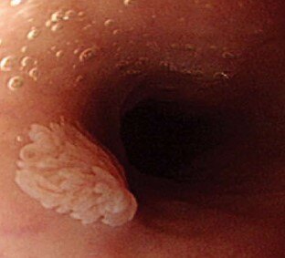 食管乳头状瘤白色图片