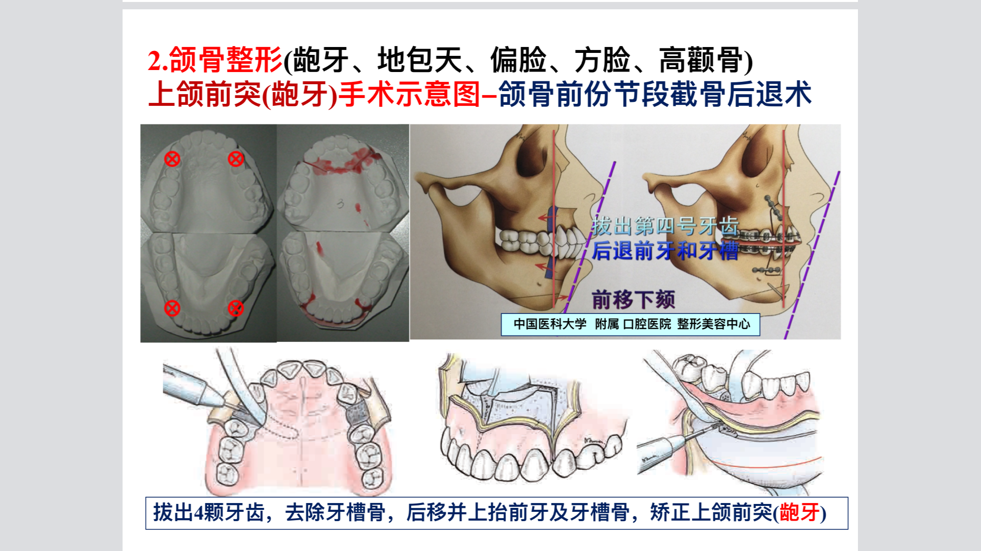 調整到合適的位置後用鈦板和鈦釘固定