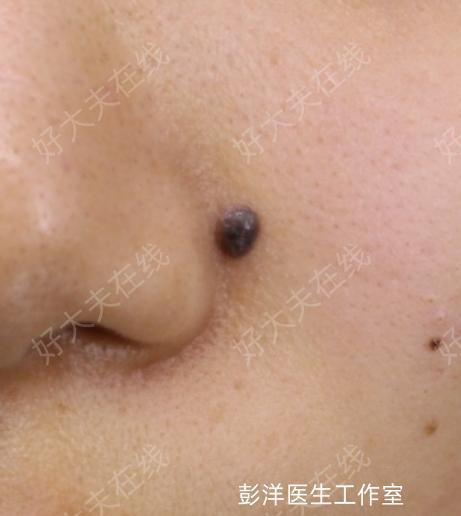 痣彭洋副主任医师北京大学第一医院皮肤性病科1937人已读评论1直播回