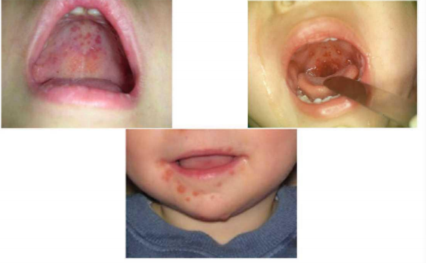 疱疹性咽峡炎的疱疹只出现在口腔里 ,最常见的位置是腭舌弓,软腭和