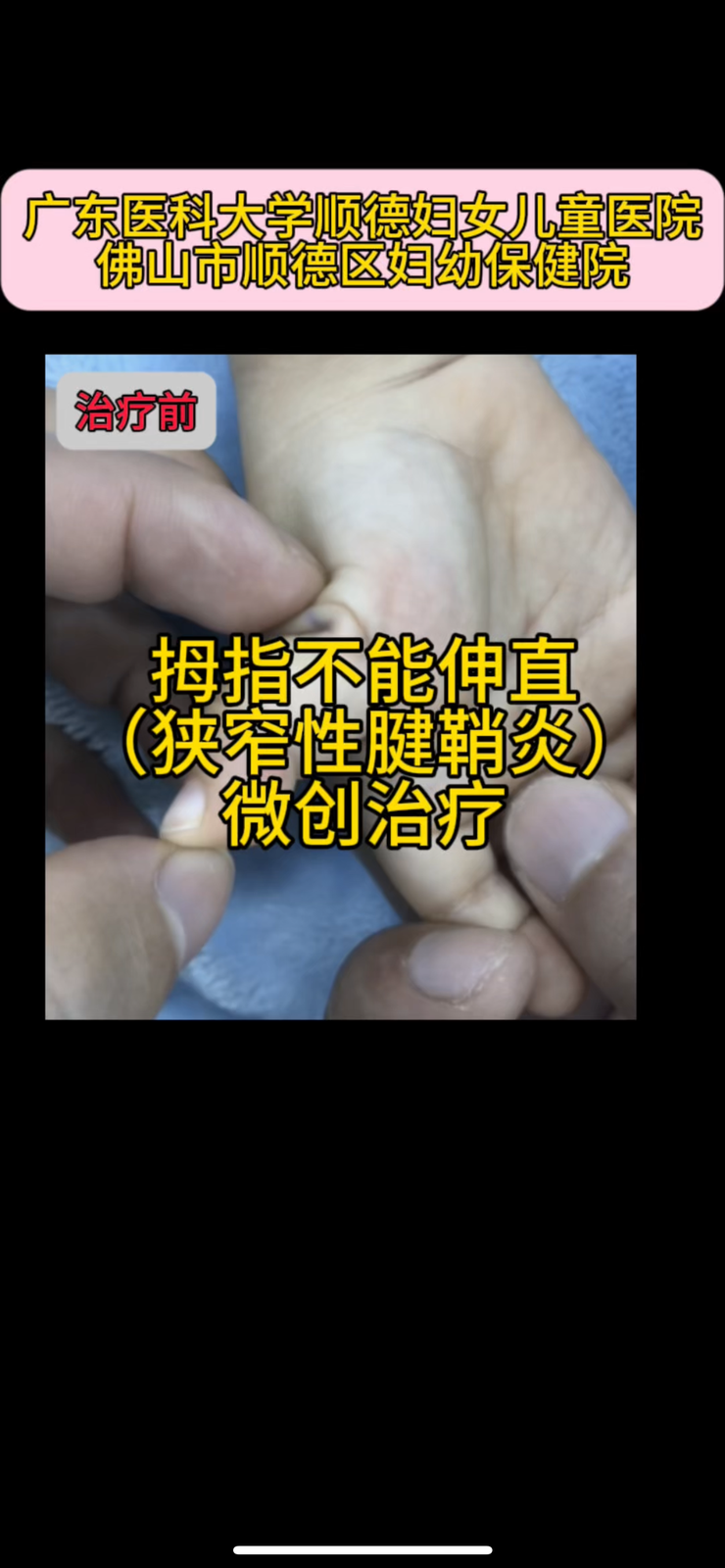 儿童狭窄性腱鞘炎的微创治疗: 拇指不能伸直,掌指关节处可摸到硬结