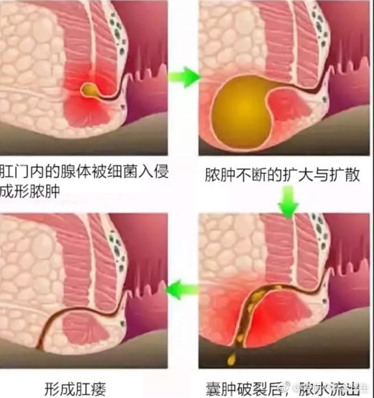 夏天常见的肛肠疾病系列如何预防肛周脓肿