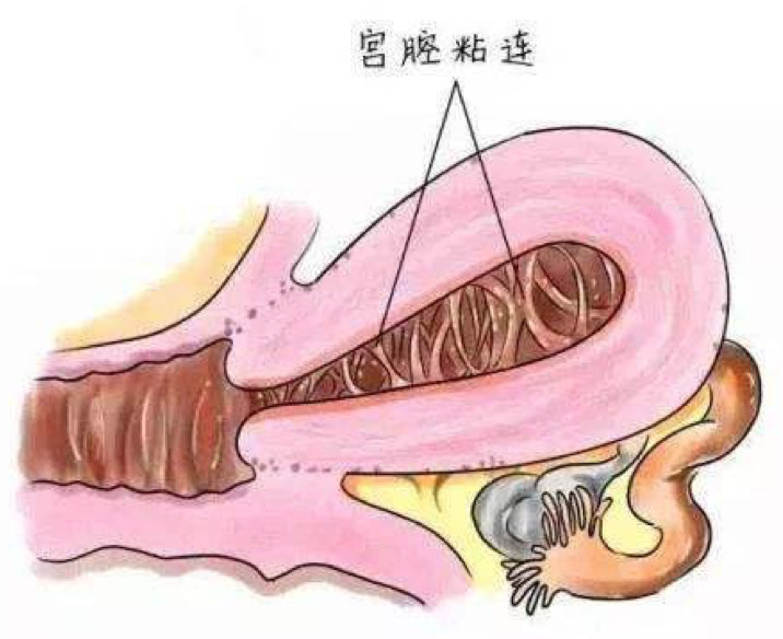 子宫内膜毛糙图片图片
