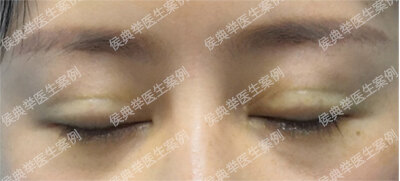 双眼皮失败的十种表现 下 双眼皮手术 双眼皮手术