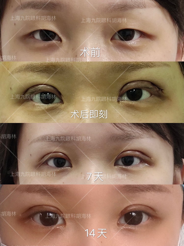 顕微鏡下眼形成手術 = OCULOPLASTIC SURGERY THROUG…-