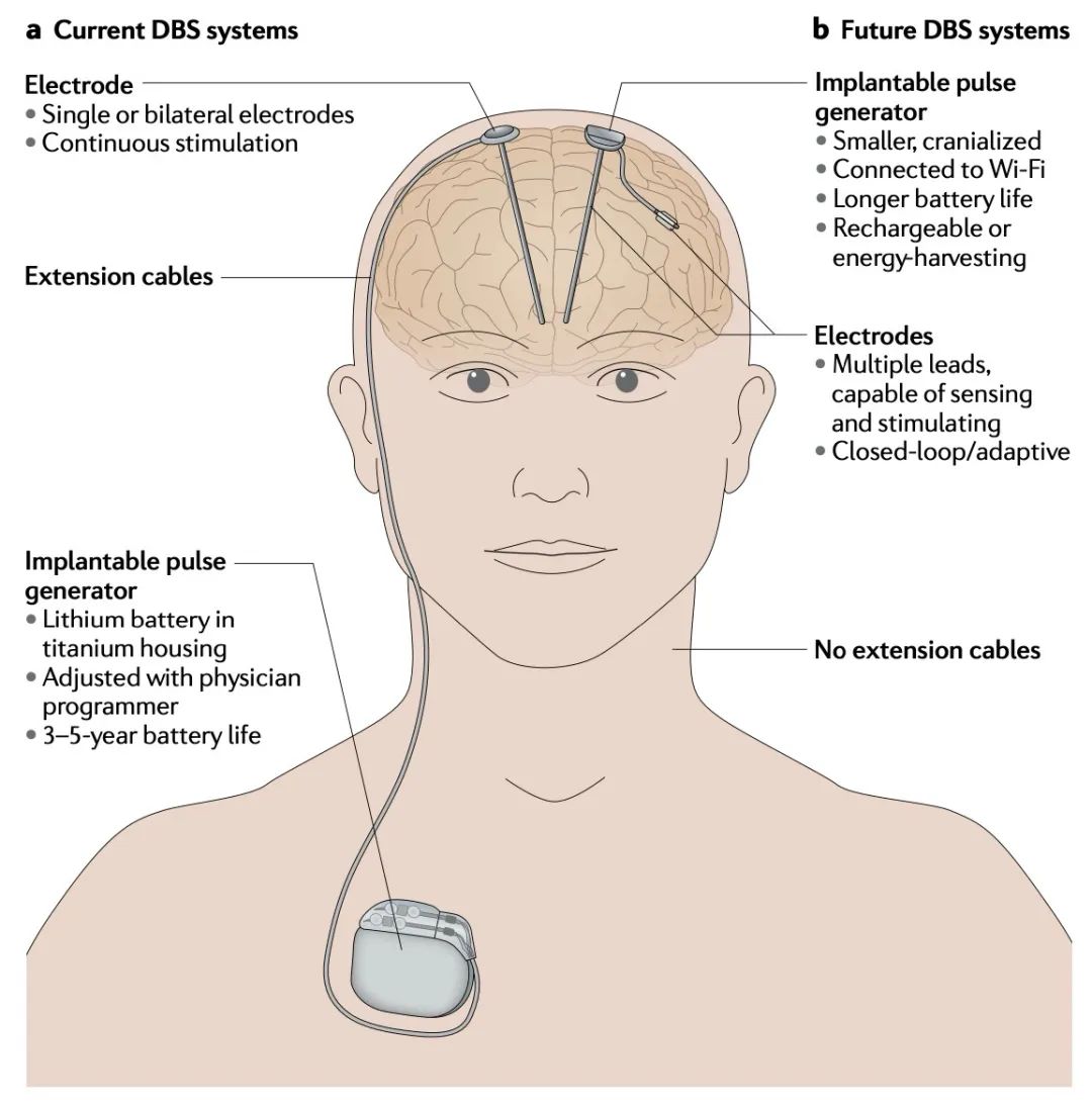 神外科普 | DBS术式（一）：DBS的前世今生 - 好大夫在线