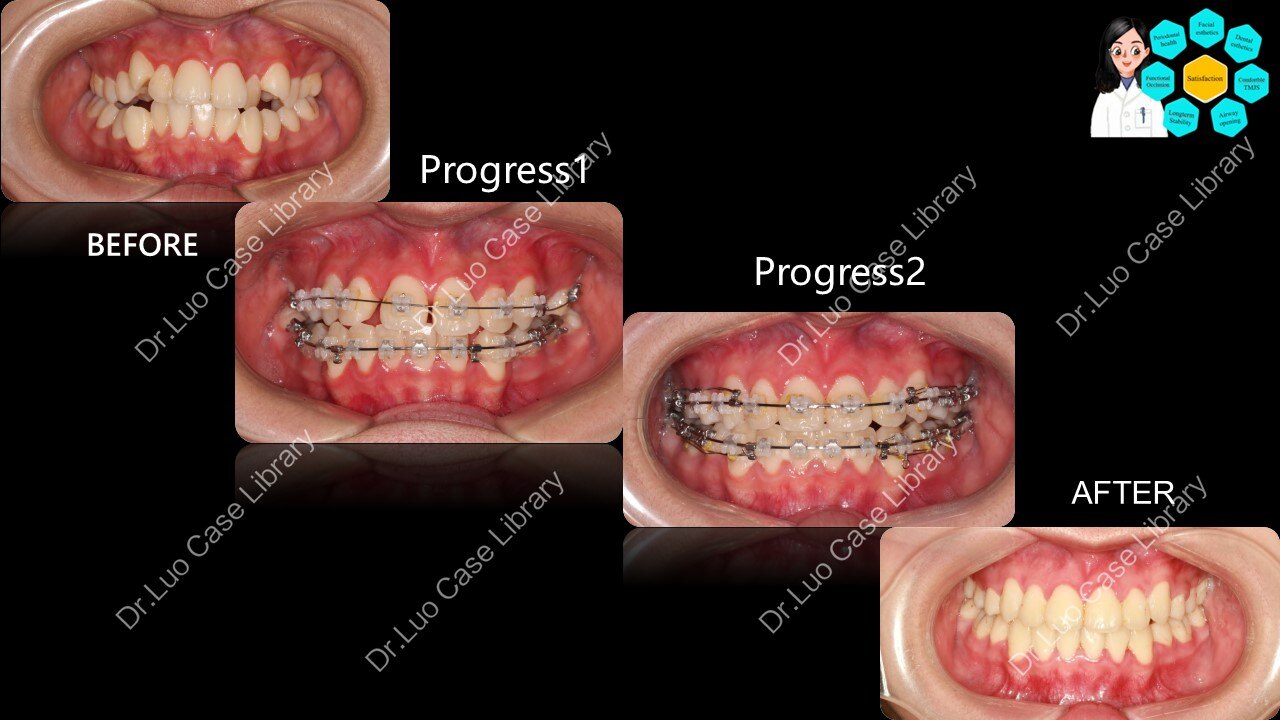 #开合##牙列拥挤##拔牙矫正##青少年矫正#案例分享_牙颌畸形_牙颌畸形