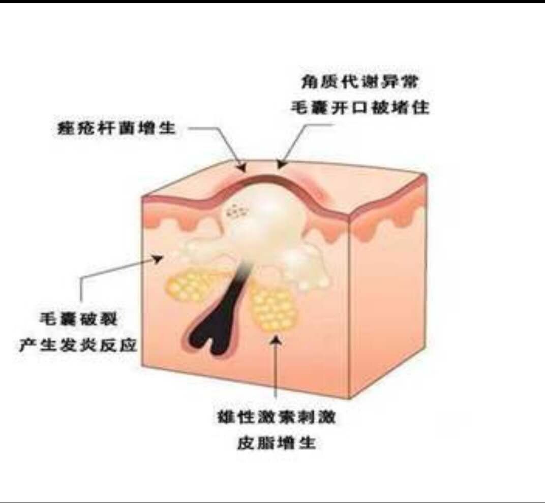 痤疮(青春痘)治疗攻略