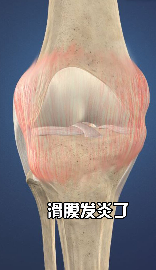 膝盖滑膜炎图片外观图片