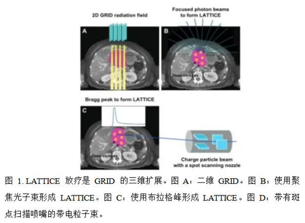 空间分割放疗（spatially fractionated radiation，SFRT）概述 - 好大夫在线