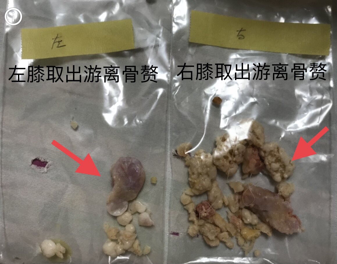 膝關節疾病之遊離體