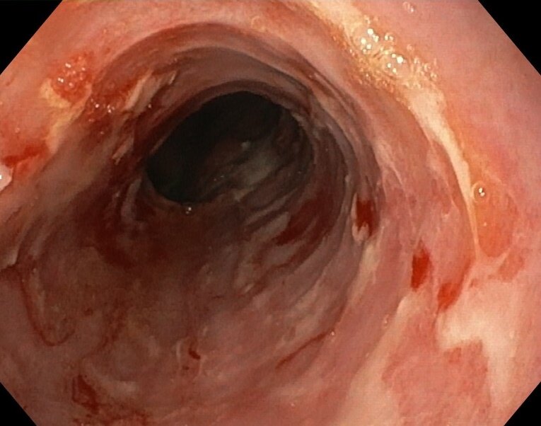 反流性食管炎症状有哪些这些别不当回事可能得治