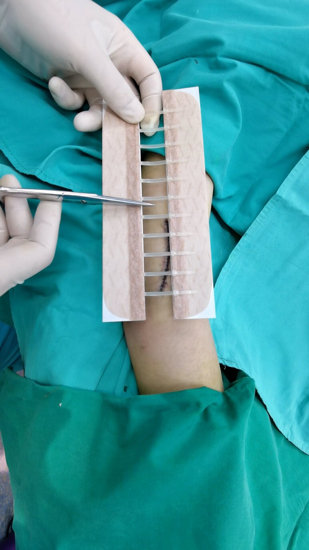 皮肤减张器保姆级使用教程_疤痕_疤痕如何预防 - 好大夫在线