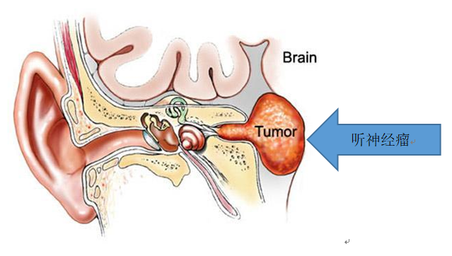 听神经瘤位置图图片