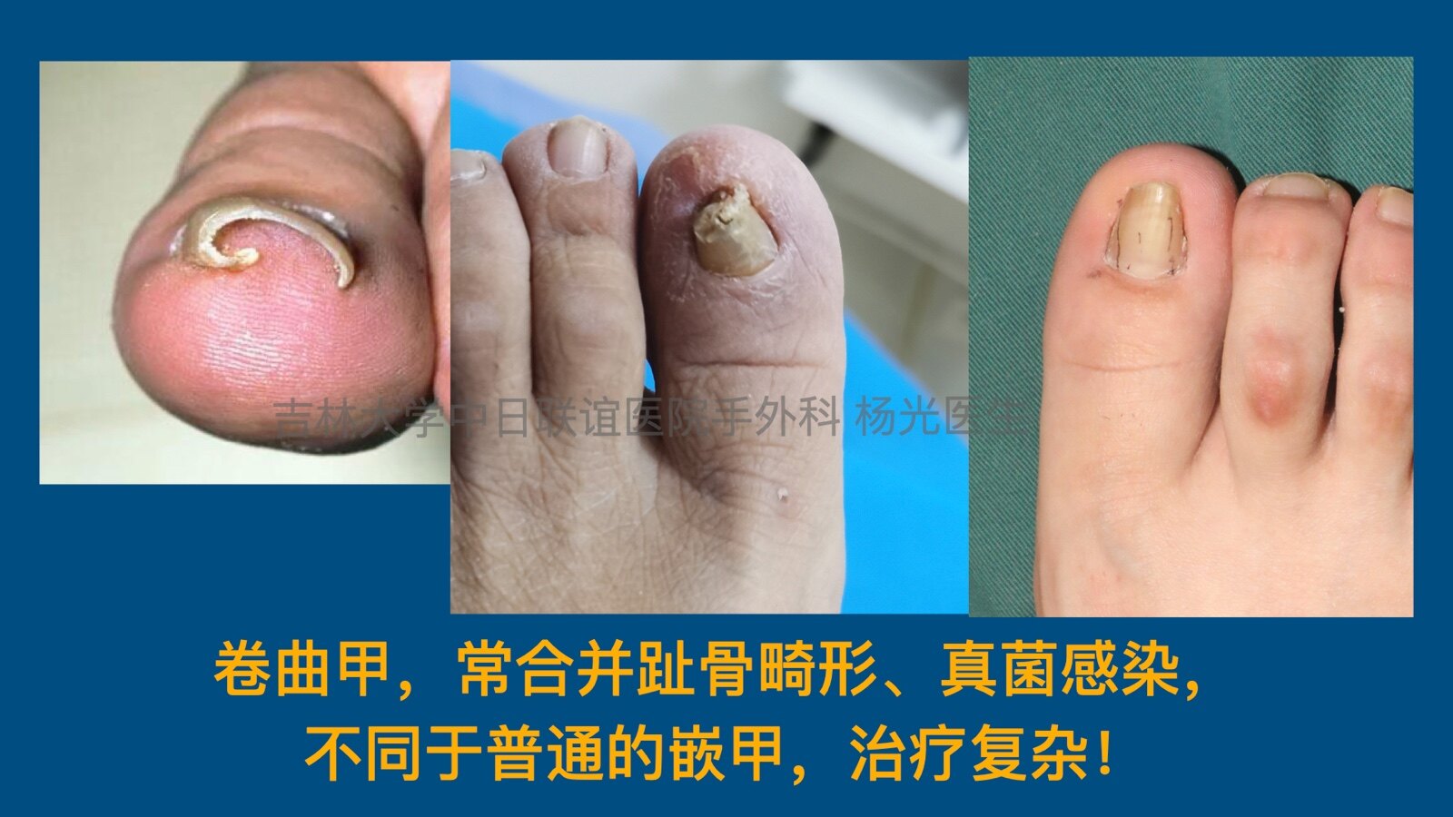 甲沟炎,嵌甲的治疗 - 好大夫在线