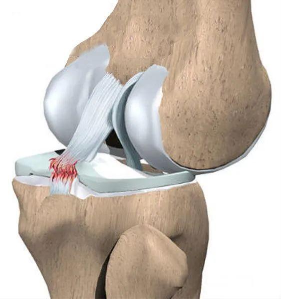 后叉韧带损伤的诊断治疗_膝关节韧带损伤_介绍_检查_治疗方式 - 好