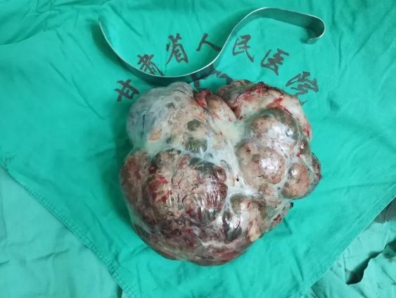 腹腔巨大肿瘤切除病例分享 - 好大夫在线