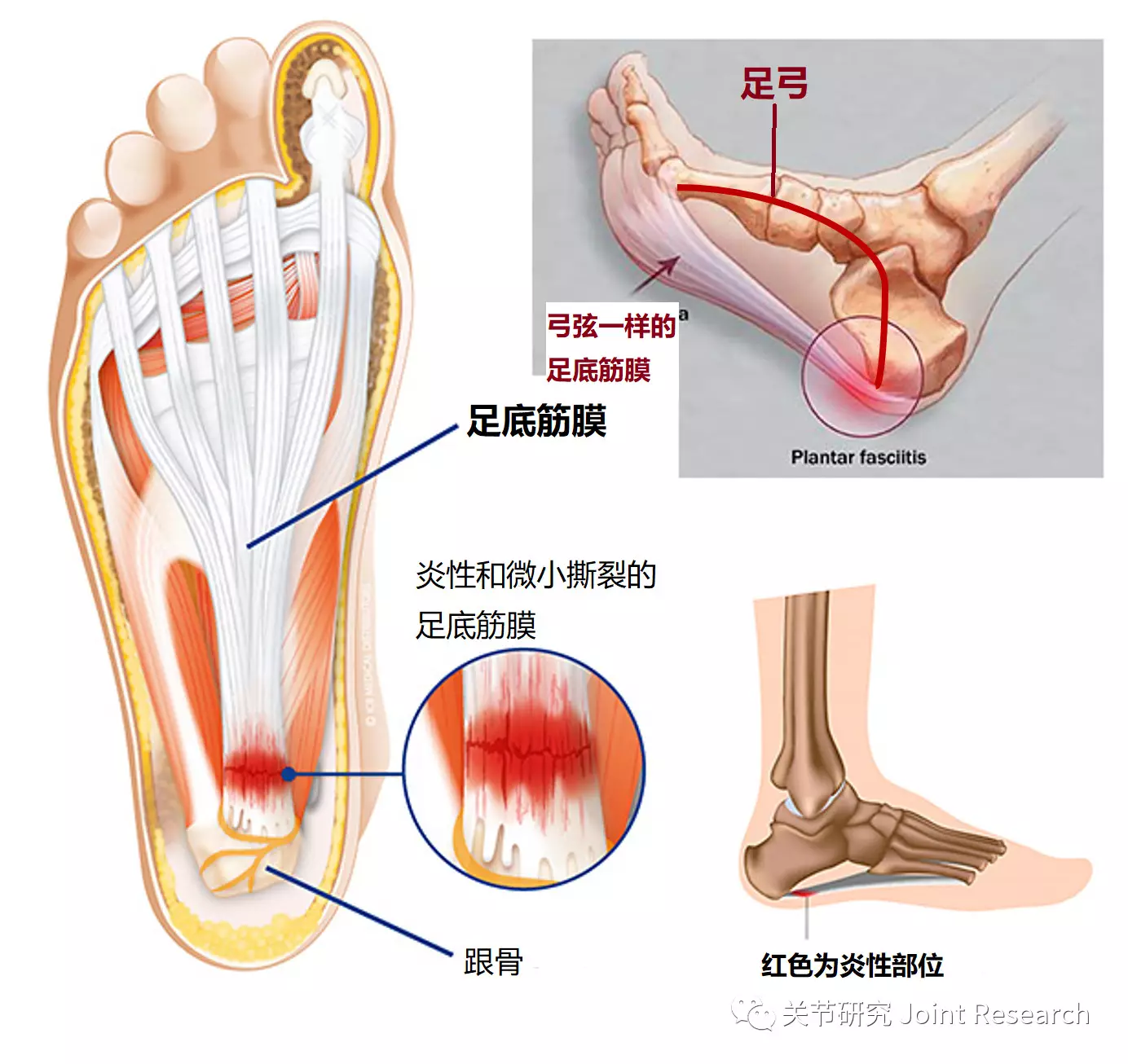 足底板痛之 足底筋膜炎 时珍网 足底板痛之 足底筋膜炎 时珍网