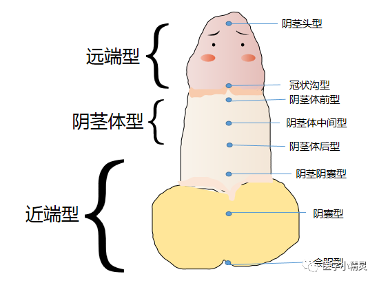 尿道下裂分型图片