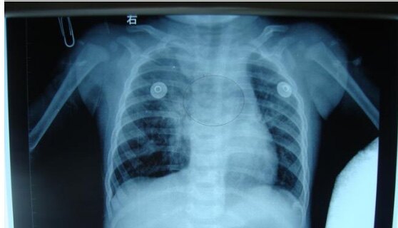 纵隔疝的临床表现与诊治方法