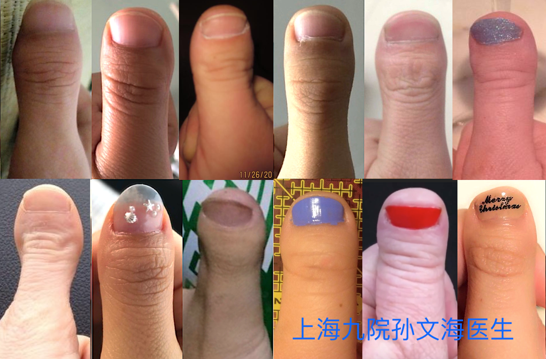 d型短指—又短又宽的大拇指到底能治疗吗?