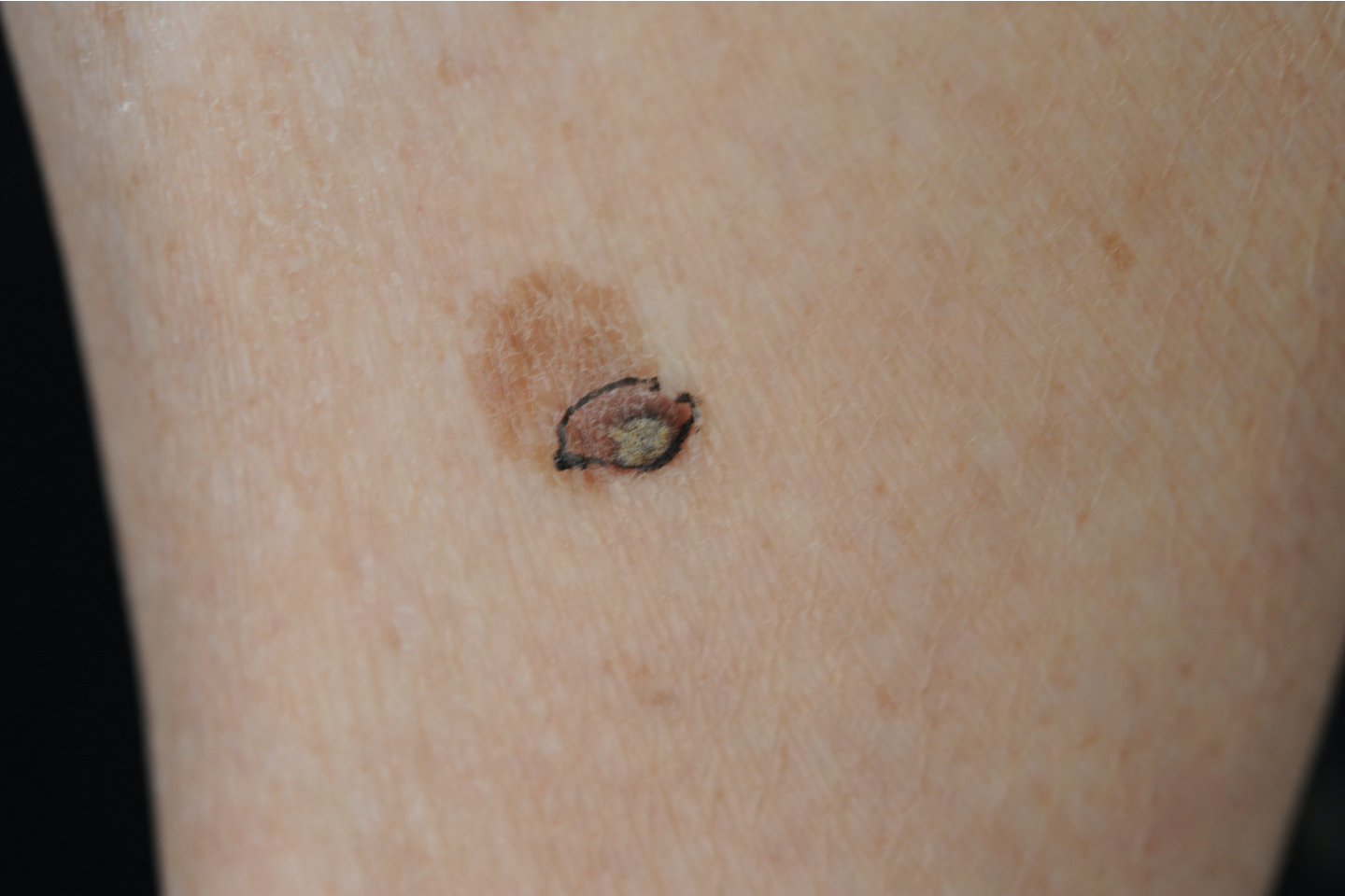 鳞状皮肤癌早期症状图片