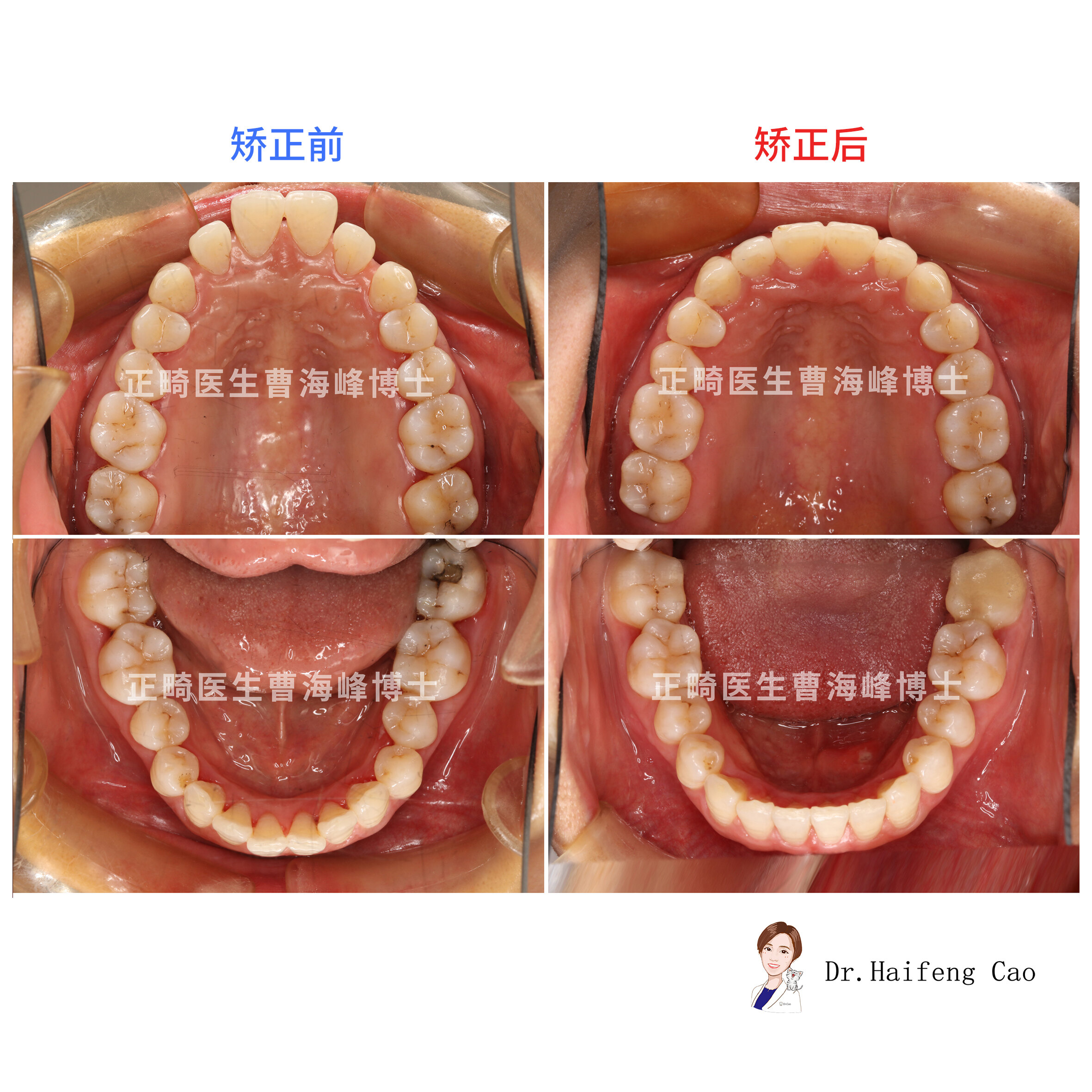 【牙凸 牙間隙矯正案例】_牙頜畸形 - 好大夫在線